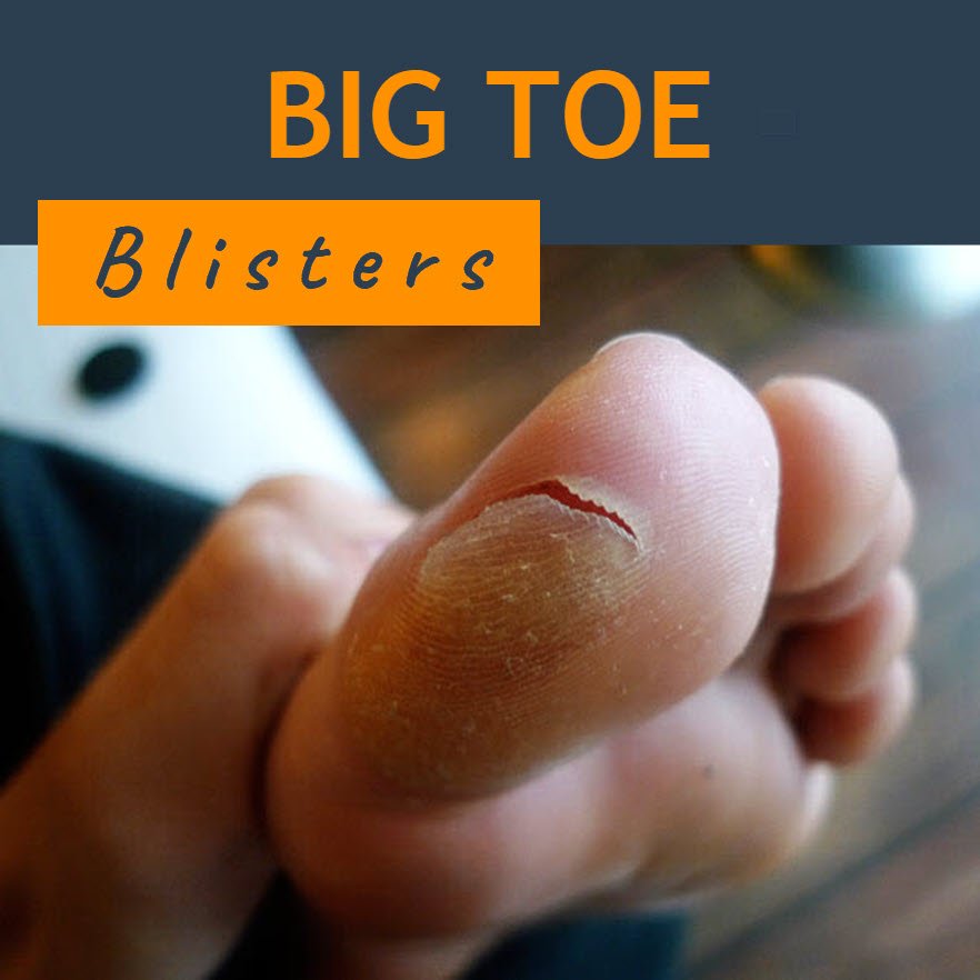 Blisters on Big Toe Big Toe Blisters Causes & Treatment
