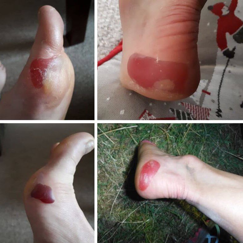 edge blisters